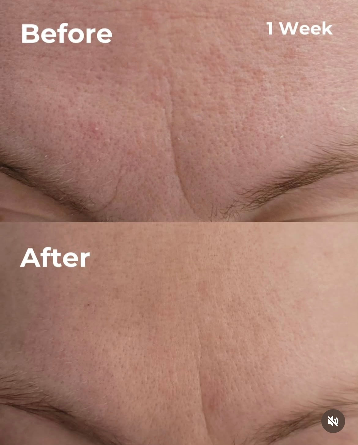 Retinol Renew 1%